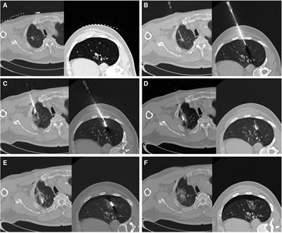 Feasibility analysis of CT-guided thermal ablation of multiple pulmonary nodules combined with intraoperative biopsy